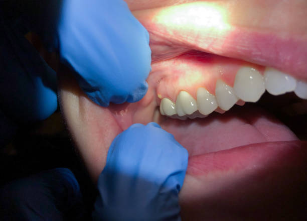 Best Emergency Denture Repair in Toast, NC